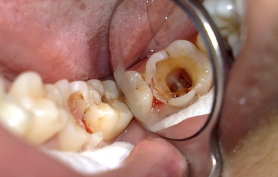 Viêm tủy răng cấp tính