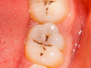 Cách chữa sâu răng hàm hiệu quả nhất